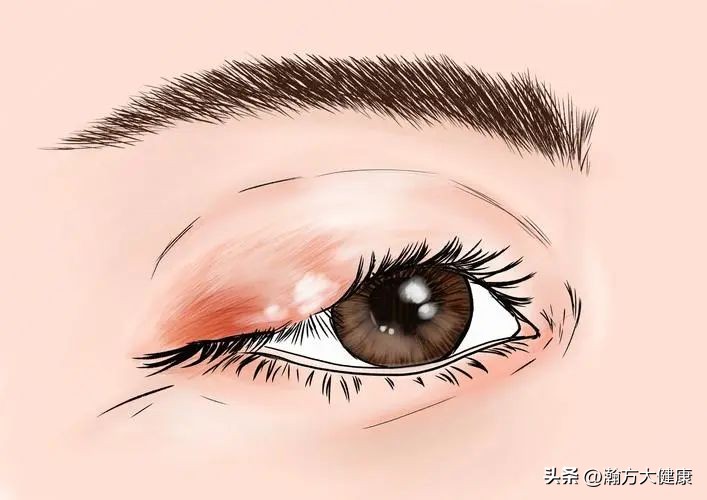 春天上火麦粒肿,麦粒肿比较好的中药