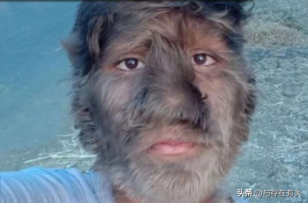 印度小伙患罕见疾病视频,印度8岁小孩长大后的奇闻异事