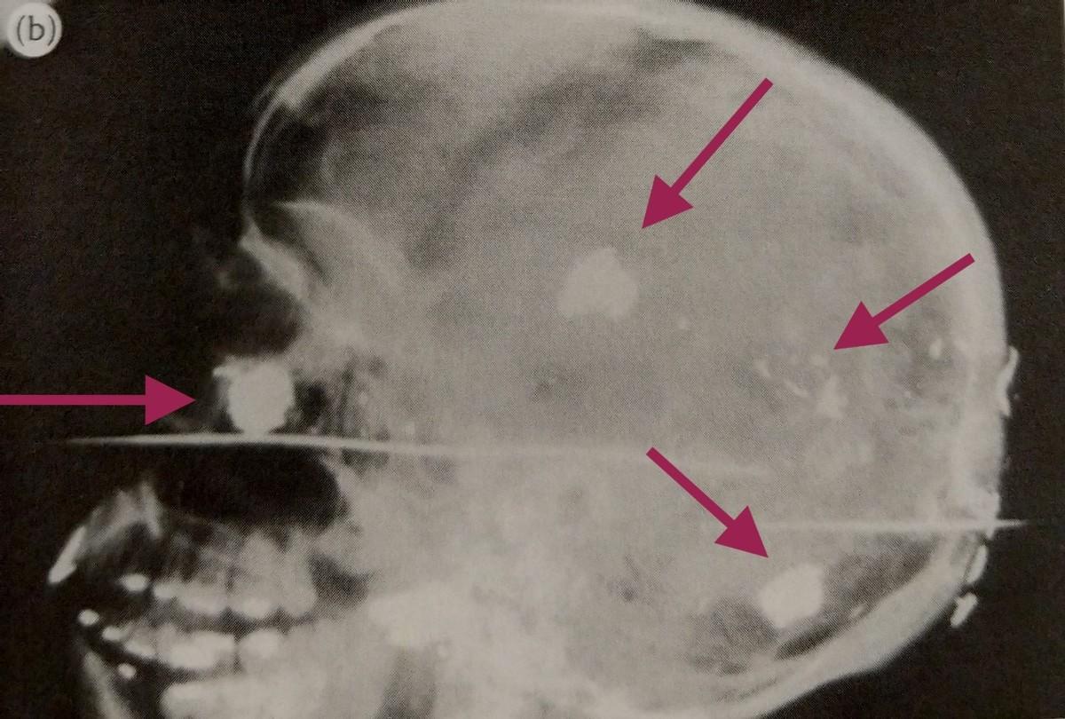 喝核辐射的水死了后骨头还在发光,喝核辐射水消失八年的人