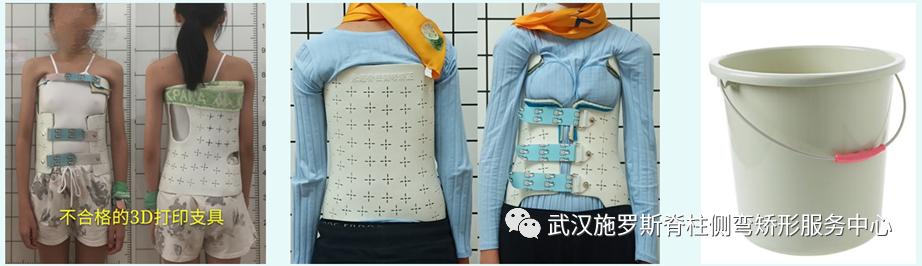 脊柱侧弯矫正支具不调整会怎样,简单辨别脊柱侧弯避免孩子走弯路