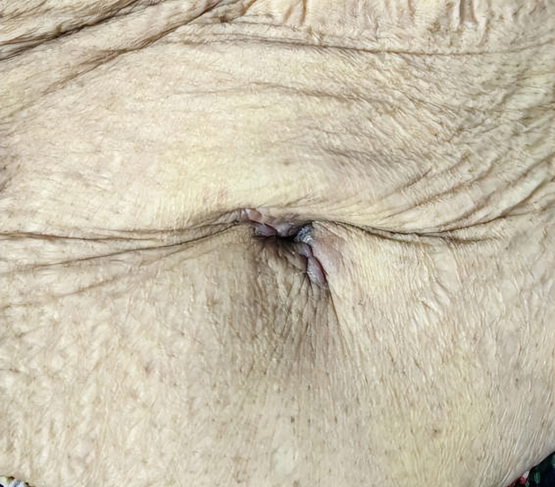 南京市鼓楼医院援圭亚那医生单孔腹腔镜下成功摘除老年巨大卵巢囊肿