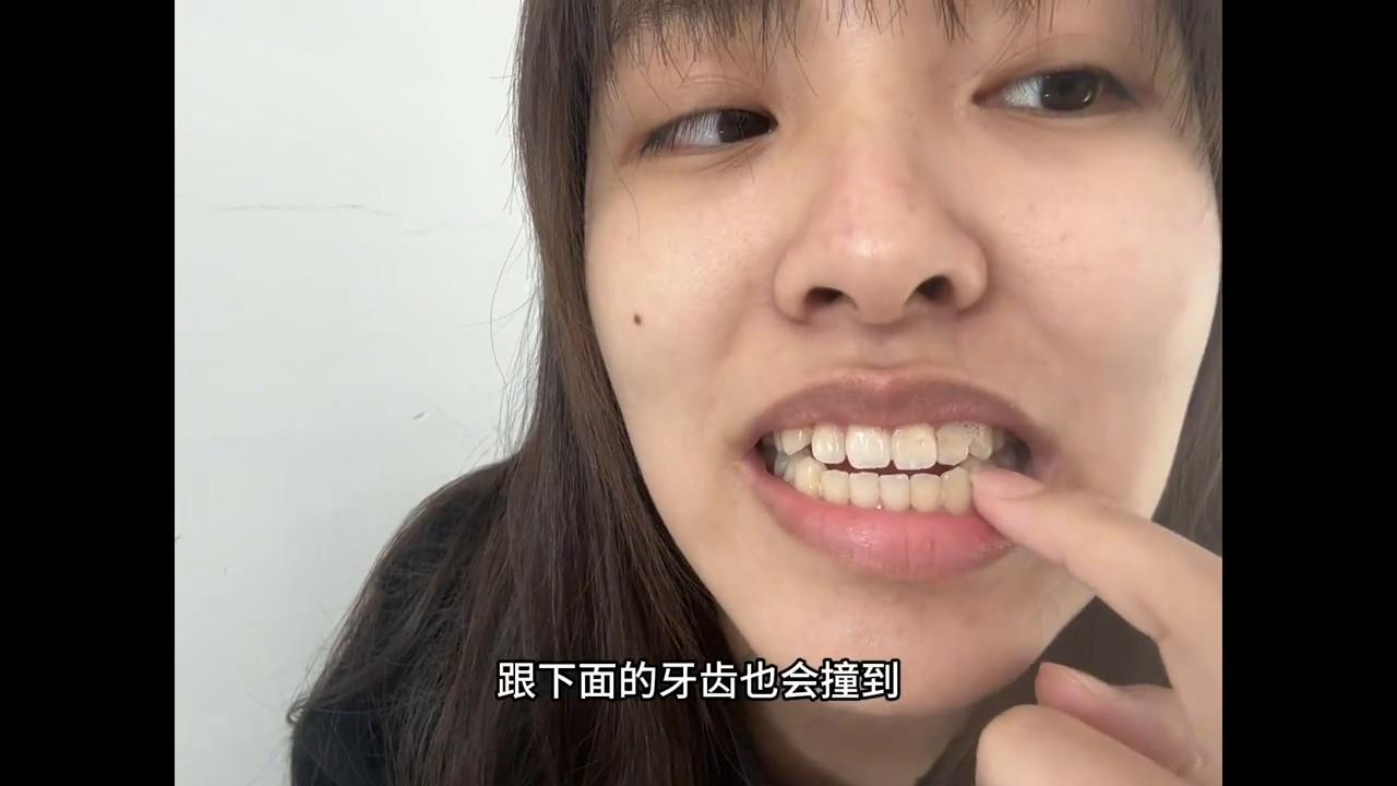 时隔两月终于给大家出这个牙齿视频了，好多人私信问我局部矫正