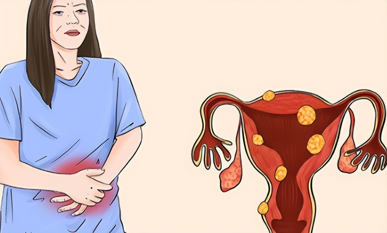 47岁女性肌瘤手术,40岁因子宫肌瘤切除子宫