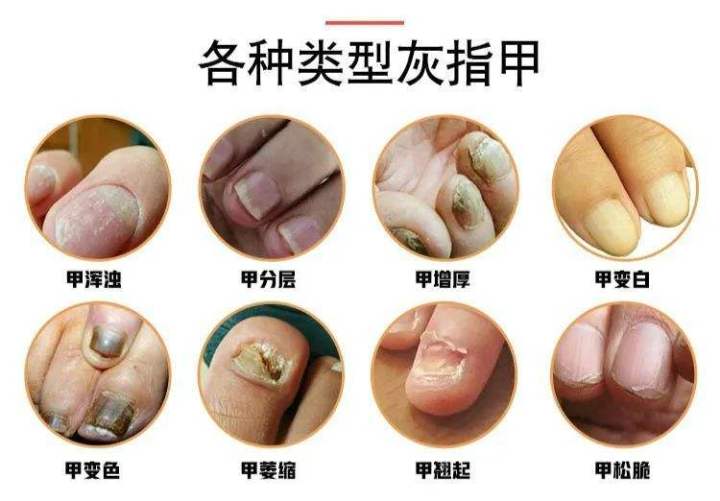 灰指甲反复处理不好根源在哪里,灰指甲治疗需要反复修理甲床吗