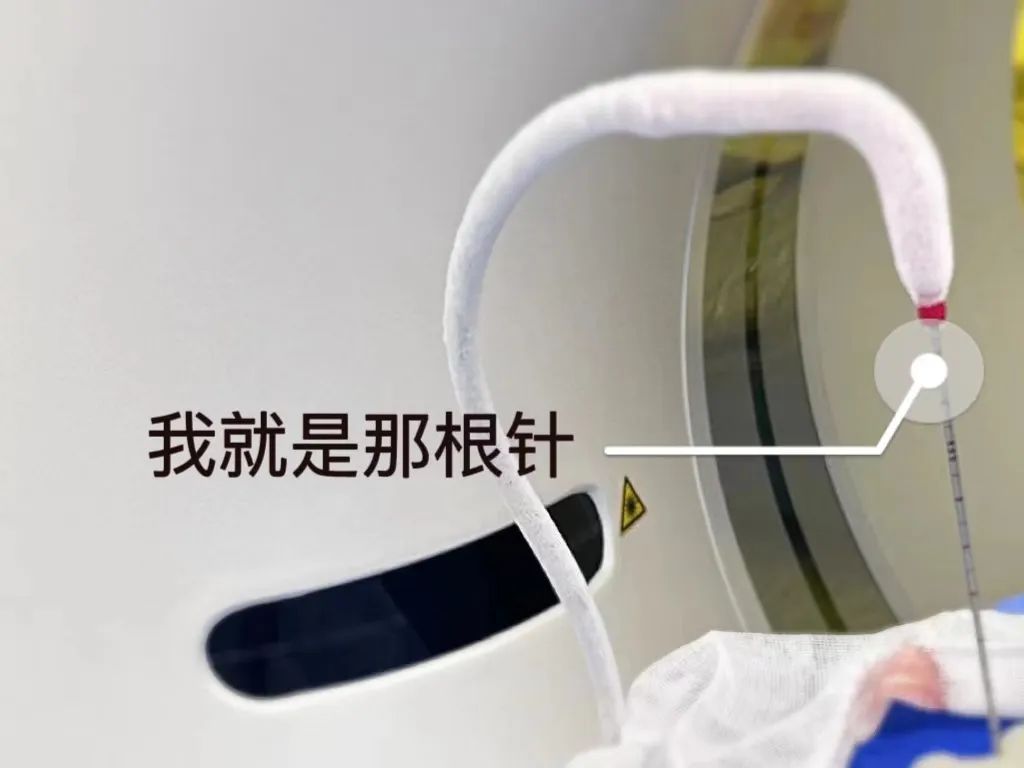 肝癌心脏转移,肝左叶巨块型肝癌微创手术