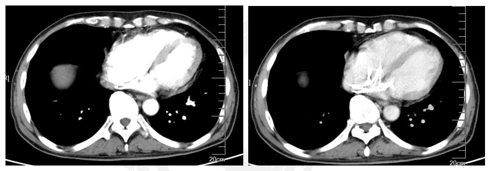 病例分享丨晚期肝癌治疗新策略，把不可能变为可能！