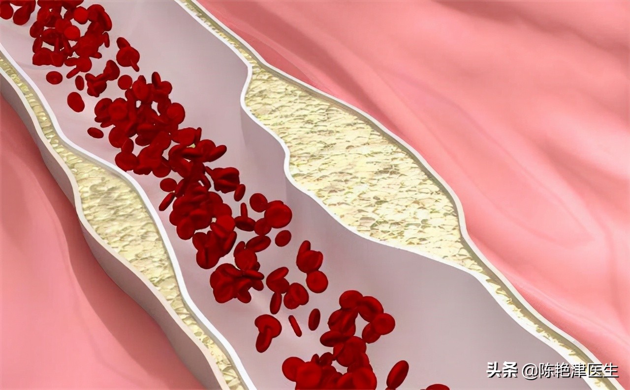 55岁大叔斑块消失，他长期坚持3个“护血管”方法，行之有效