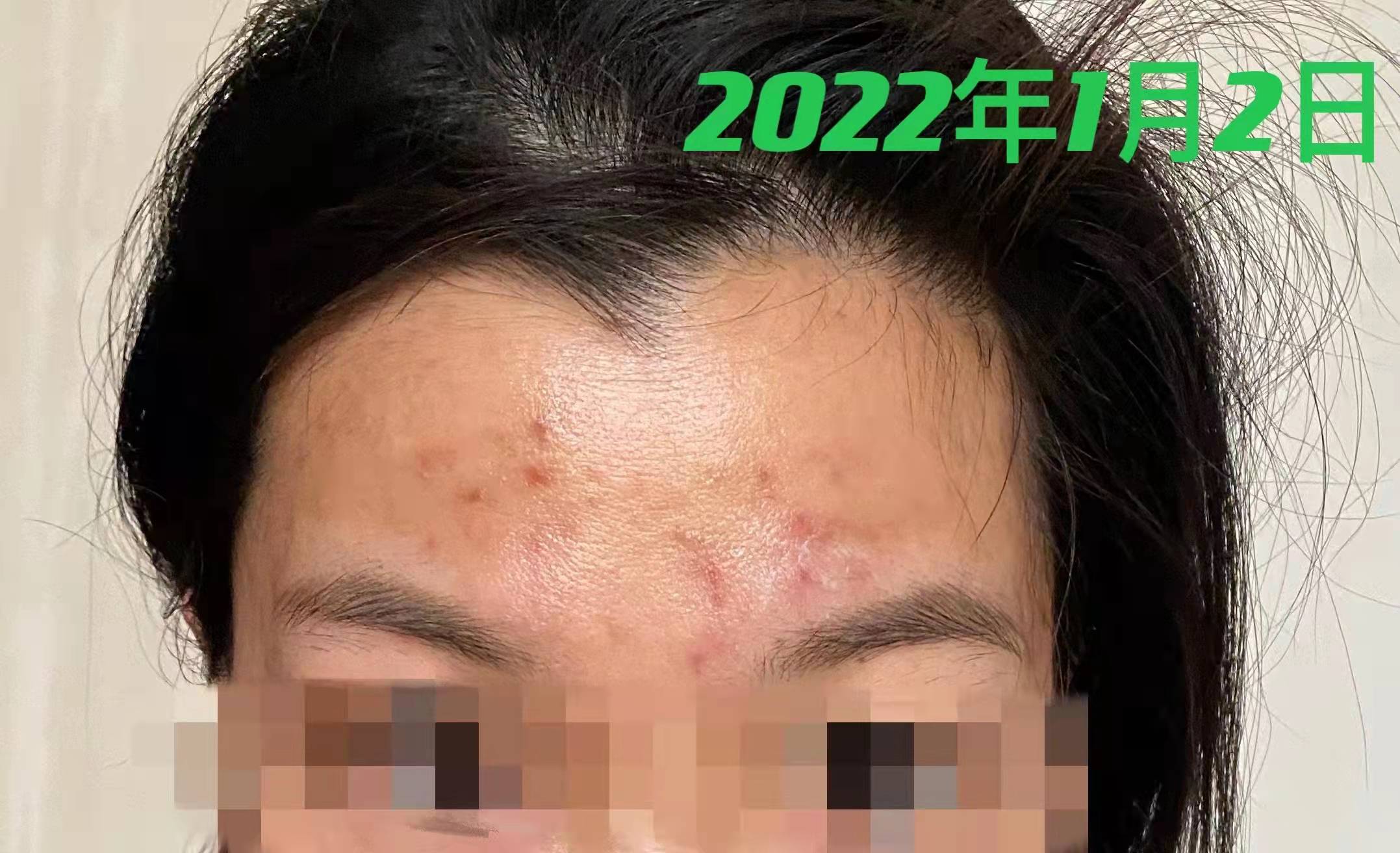 脸上有痘痘三四年了经常反反复复,30多岁脸上痘痘怎么根治