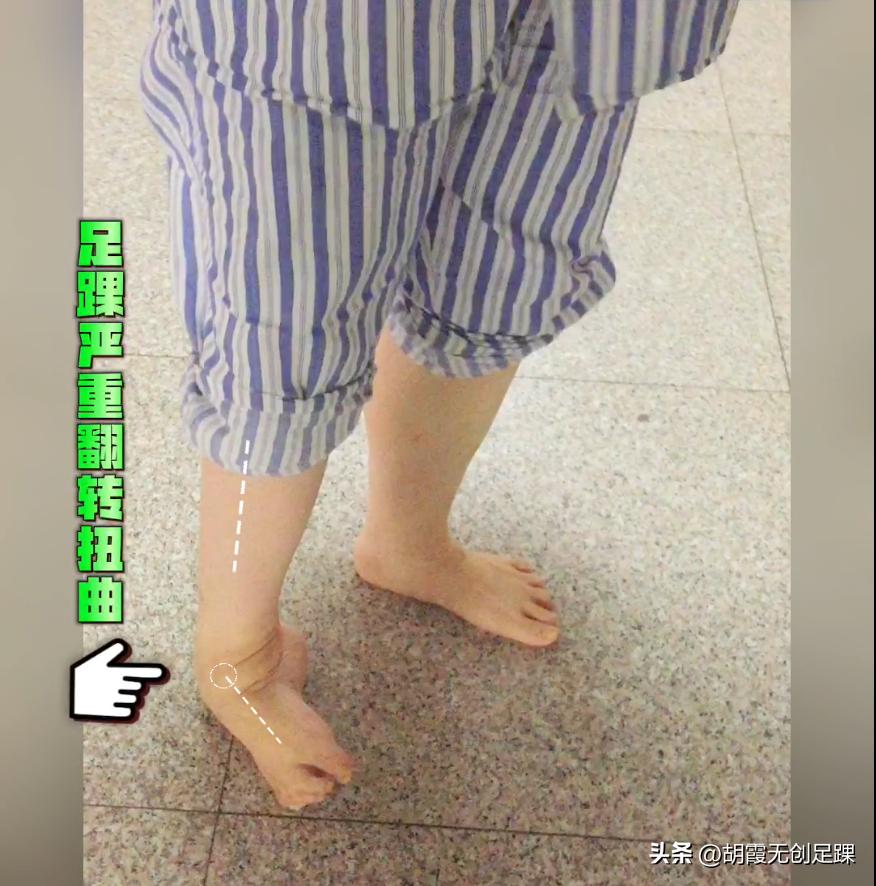 马蹄内翻足矫正后遗症,30岁严重的马蹄内翻足矫正