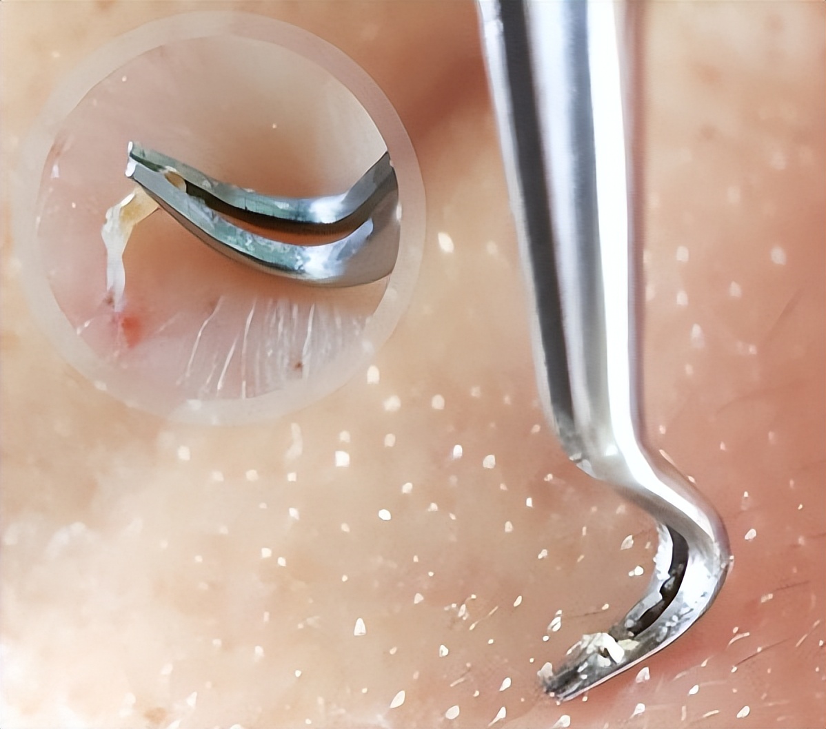 鼻子上有白白的小点可以挤吗,鼻子上黑黑的小点点怎么去除