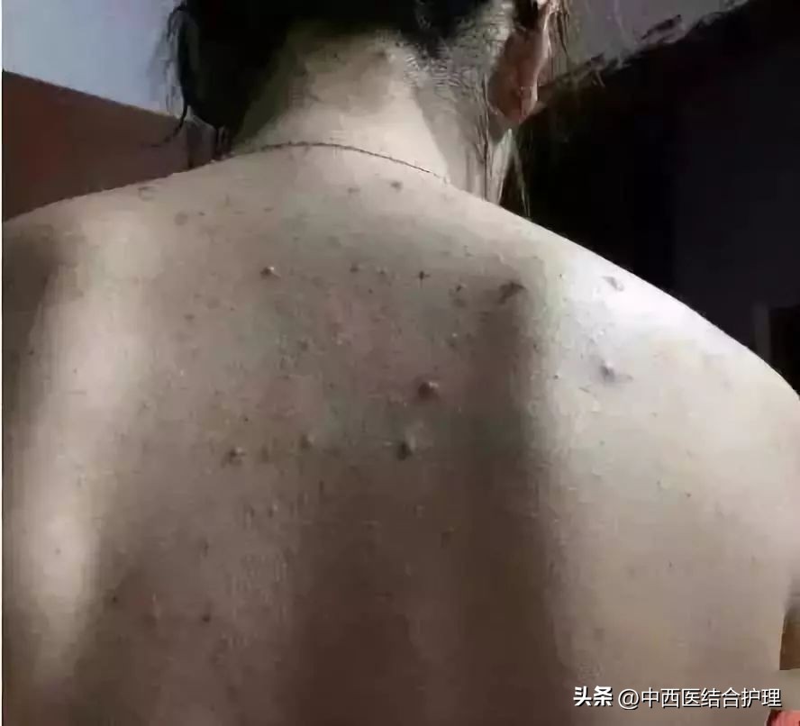 背后长许多小米粒应该怎么做,后背小米粒祛除过程