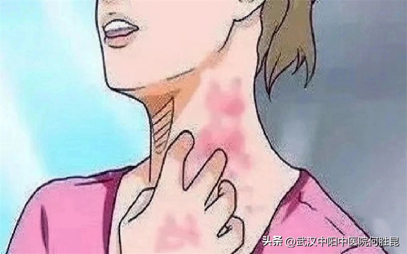 一热身上就痒发红一凉就消失,一热身上就痒起红斑一凉就消失