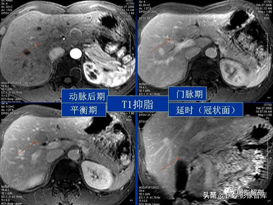 肝炎性假瘤鉴别诊断,肝炎性假瘤影像学表现