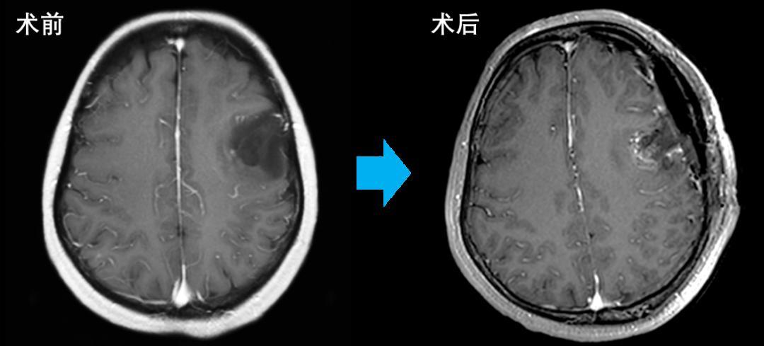 全国技术最先进的肿瘤医院,中国治愈胶质瘤的新药