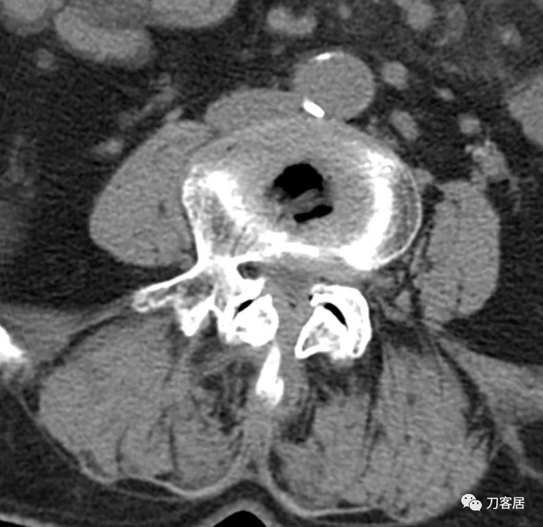 老年人腰骨裂不手术怎么治疗最好,老年腰椎骨质疏松症