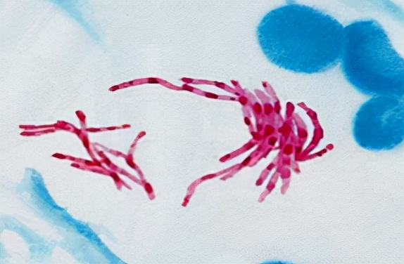 肺结核会传染给别人得肠结核吗,治疗肺结核的同时治疗肠结核吗