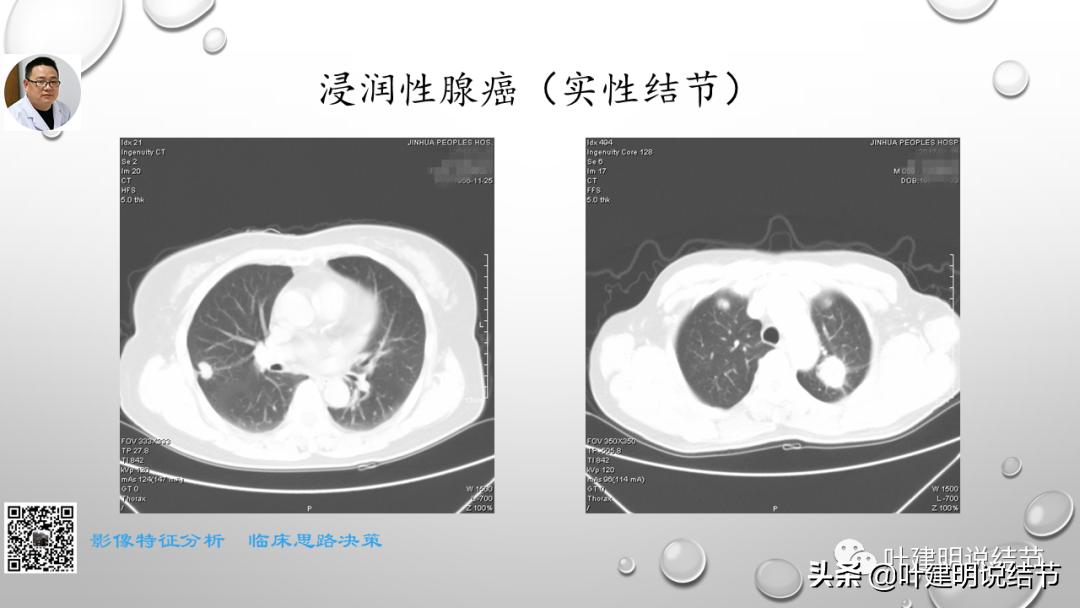 在《一脉阳光》呼吸影像诊断专题培训班上的讲课PPT（第一部分）