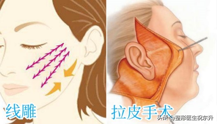 到底有没有必要做拉皮,做拉皮之前你必须要知道的6件事