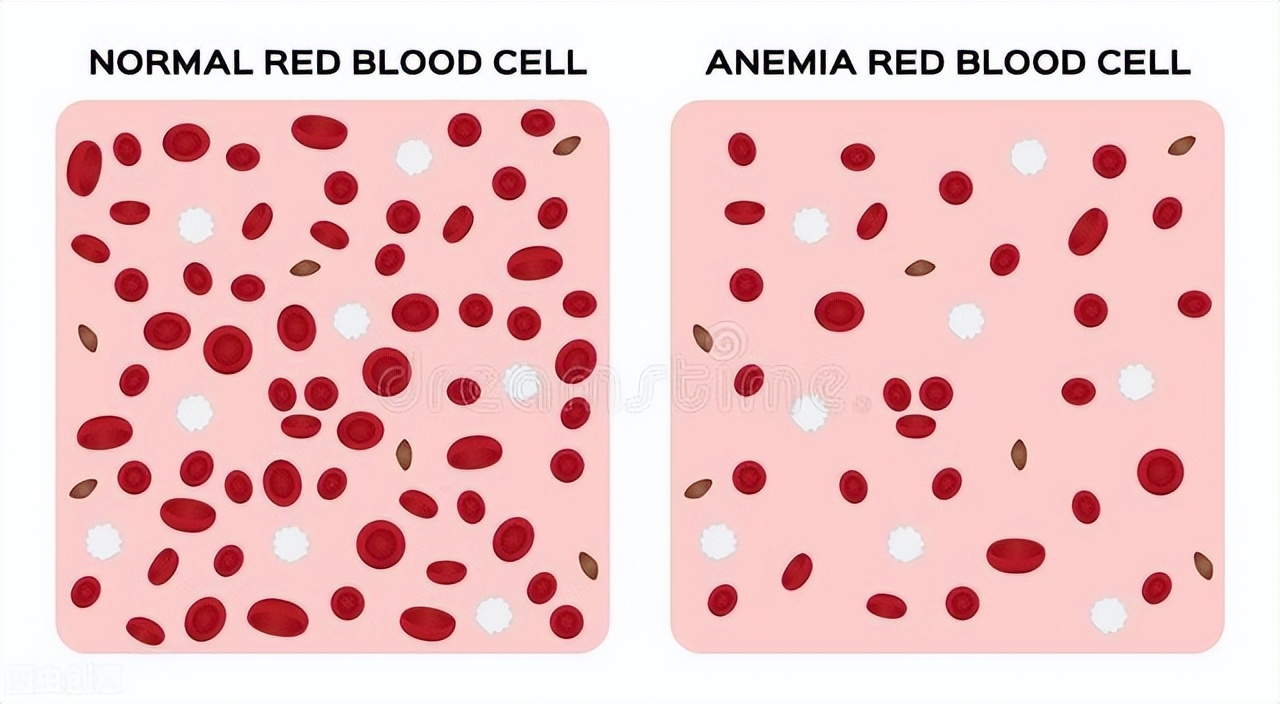贫血厉害吃什么药补血快,老年人贫血吃什么补血快