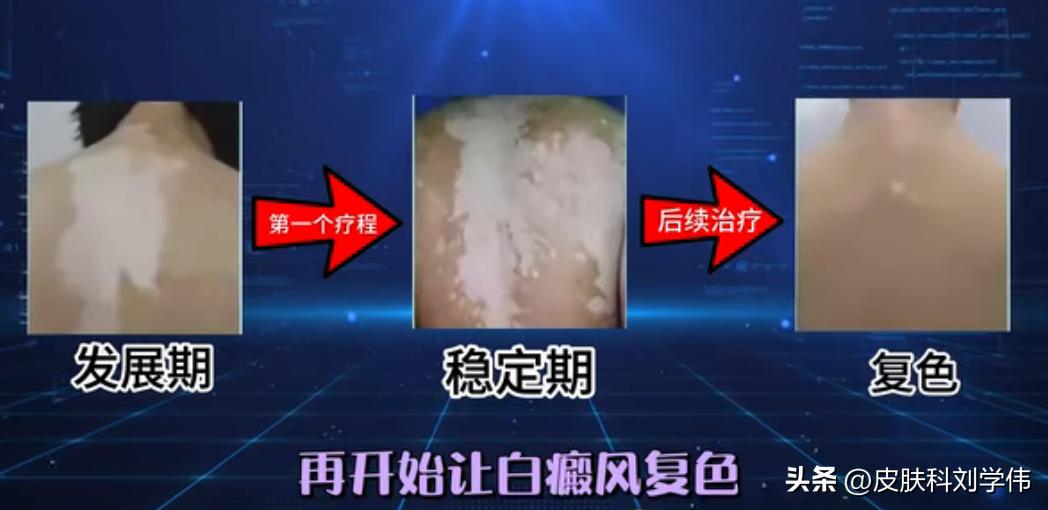 白癜风越治越多三个方法彻底治好,治疗儿童白癜风会存在哪些误区