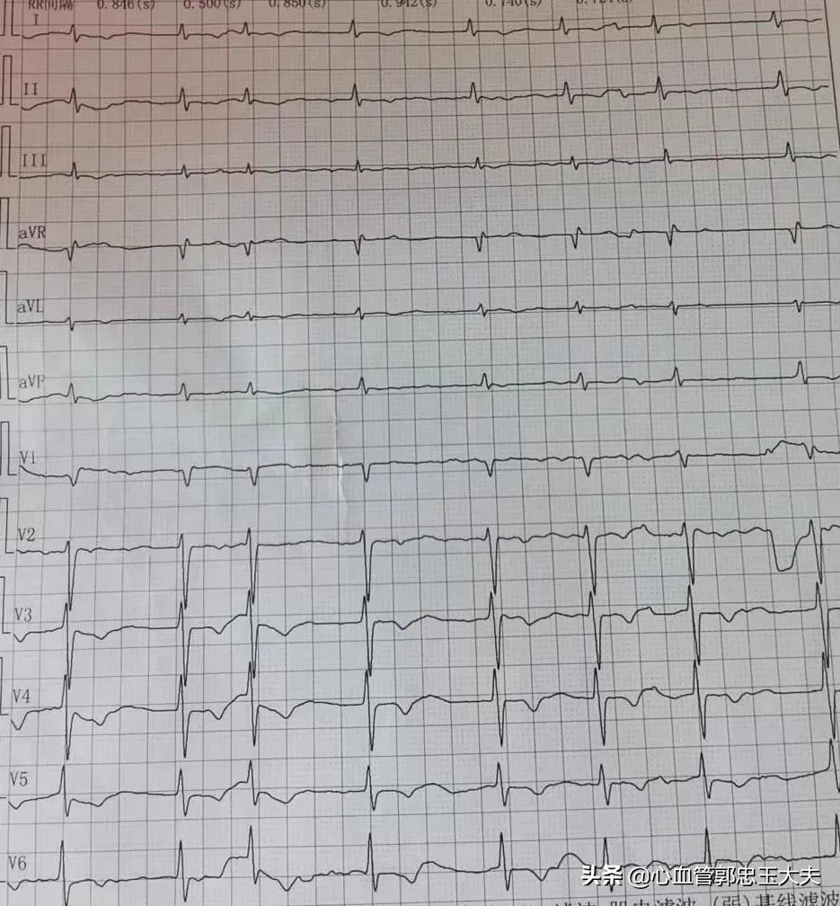 为什么支架内更容易堵,指标正常但支架内再狭窄