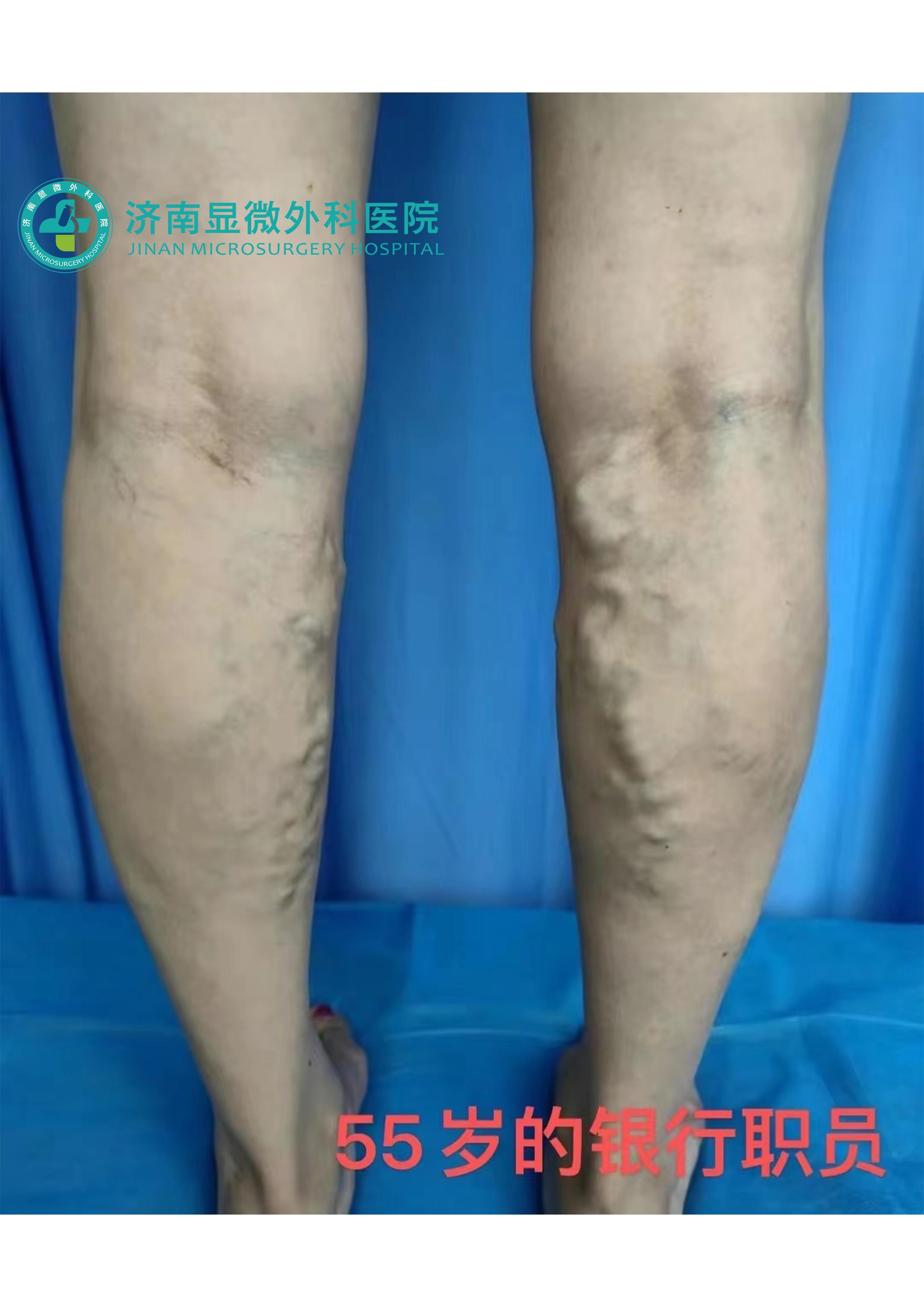 现在治疗静脉曲张有哪些治疗方法,杨医生治静脉曲张