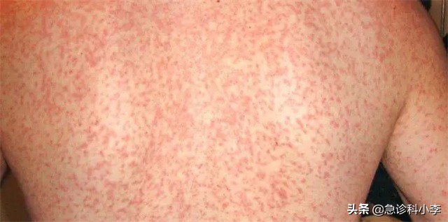 身上出现不痒的小红点是怎么回事,身上突然起了很多小红点不痛不痒