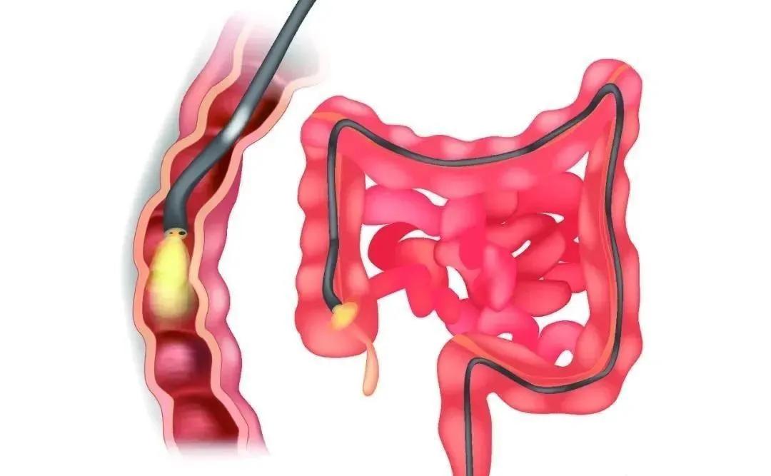 溃疡性结肠炎使用生物制剂注意事项123