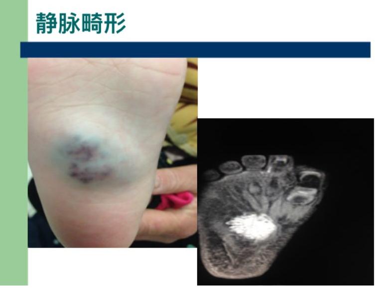 静脉血管畸形介入治疗,治疗动静脉血管畸形哪家医院最强