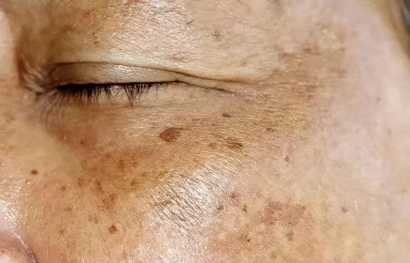 长了斑怎么能彻底治愈,长了一小块褐斑