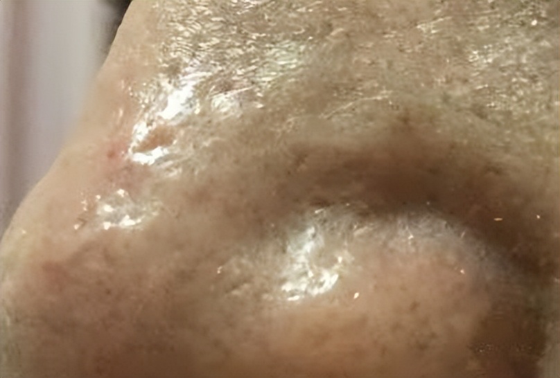 鼻头长黑粉刺怎么回事图片,鼻梁及两侧起了闭口粉刺