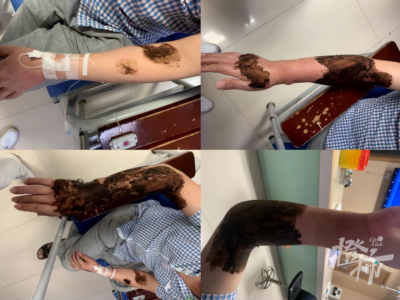 被叮了一口手上肿了个大包,被叮了一下肿了个大包