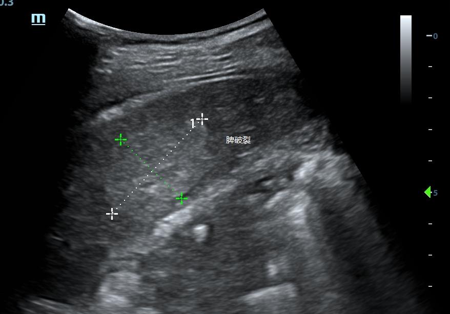 超声介入入门,手把手教你入门超声