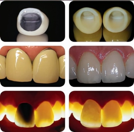 戴烤瓷牙的好处和坏处,烤瓷牙有几种它们的优缺点