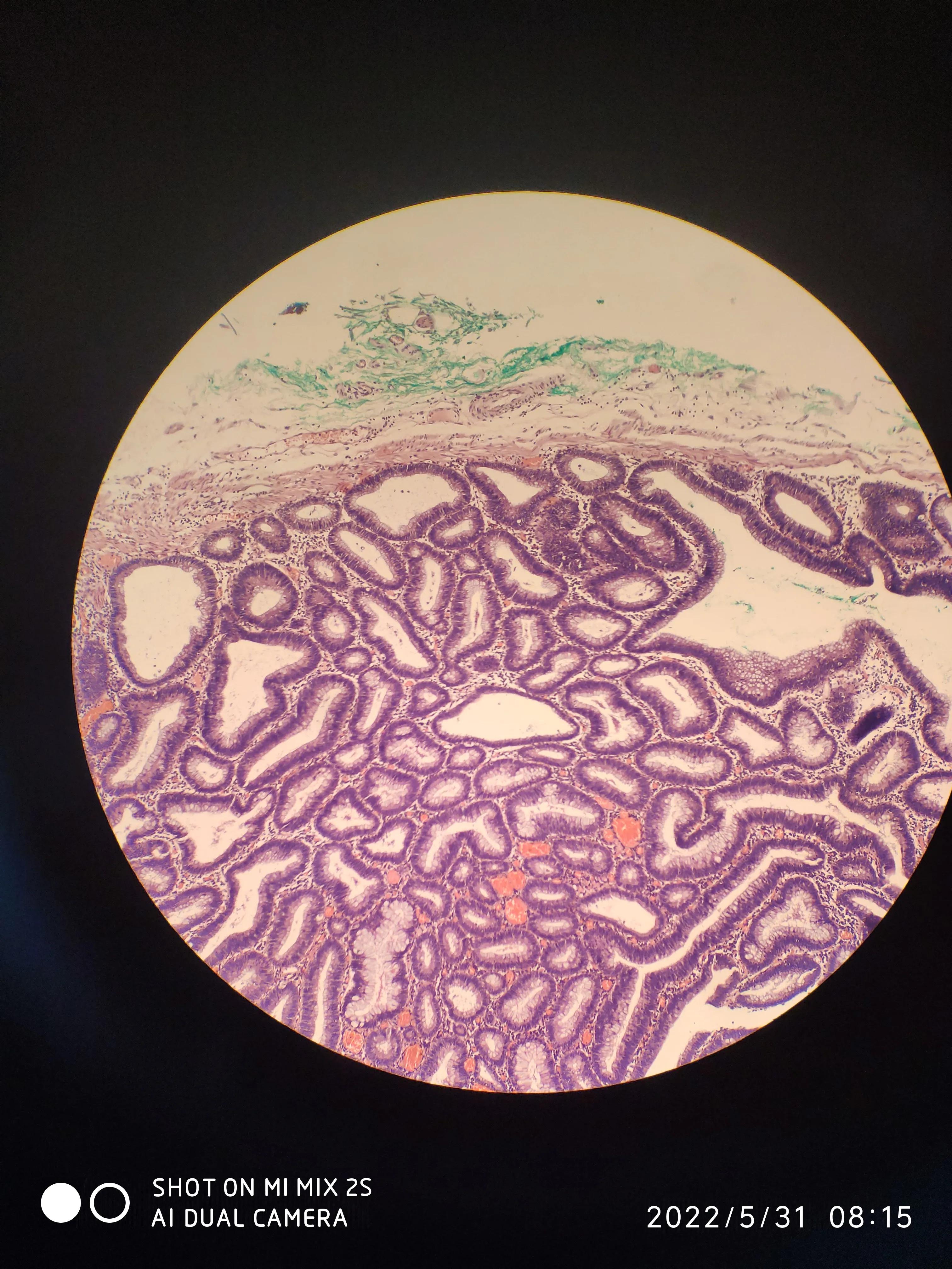 esd手术后续身体感觉,esd手术可靠吗