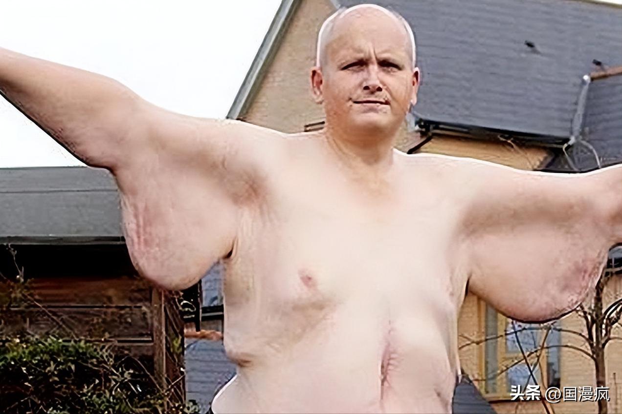 英国医生的噩梦：保罗·梅森重达1016斤，医院建议：死后拉屠宰场