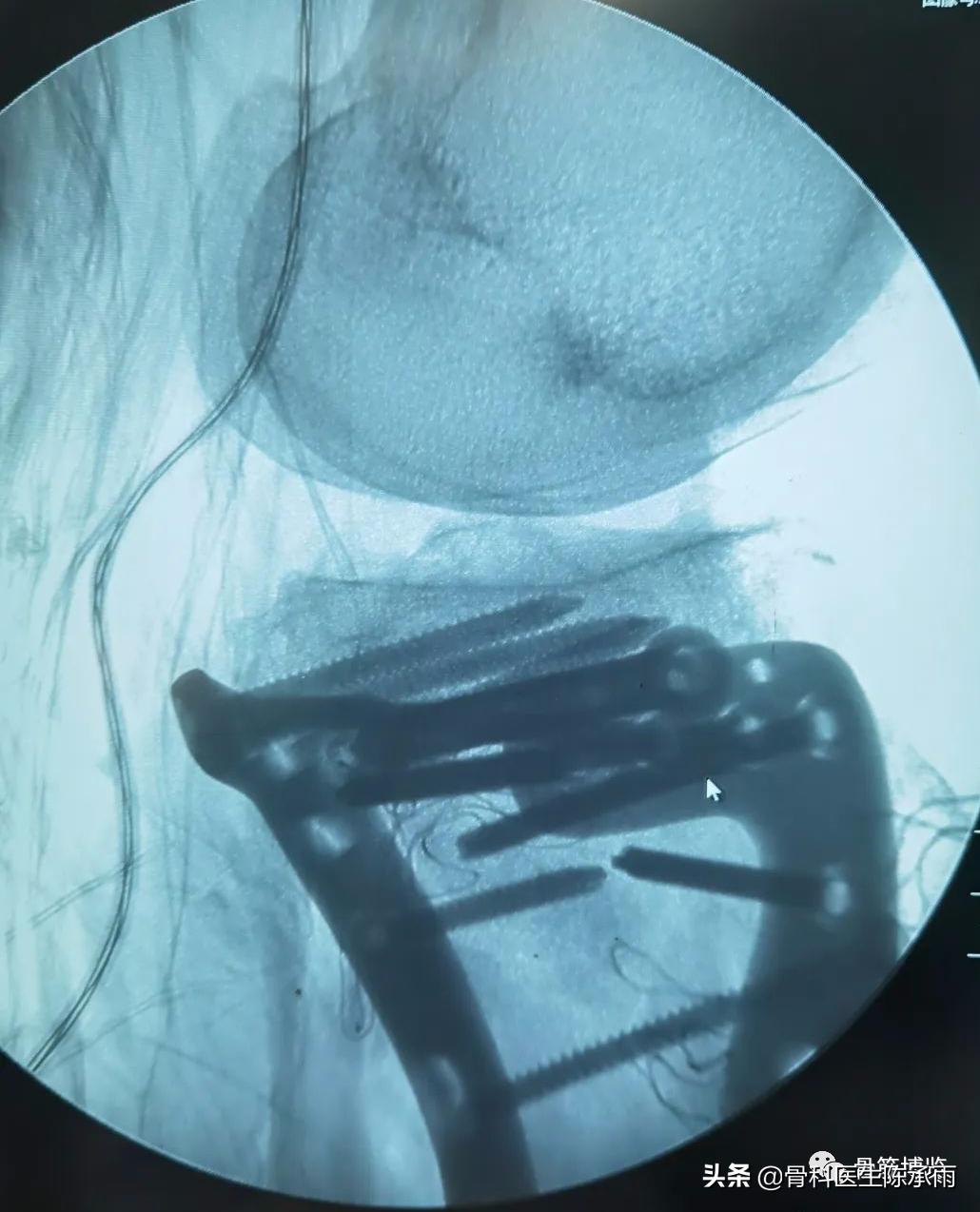 陈旧性腿骨骨折,陈旧性骨折