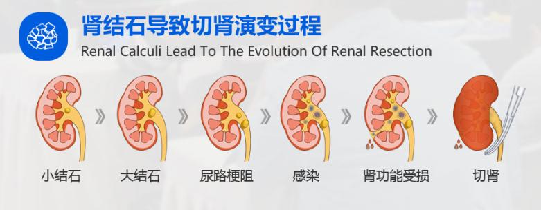检查有肾结石没有症状应注意什么,肾结石没什么症状怎么办