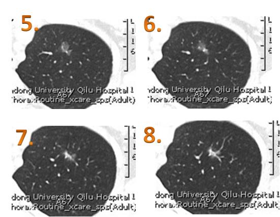 70%磨玻璃肺结节无需着急手术,磨玻璃结节5mm医生说原位癌