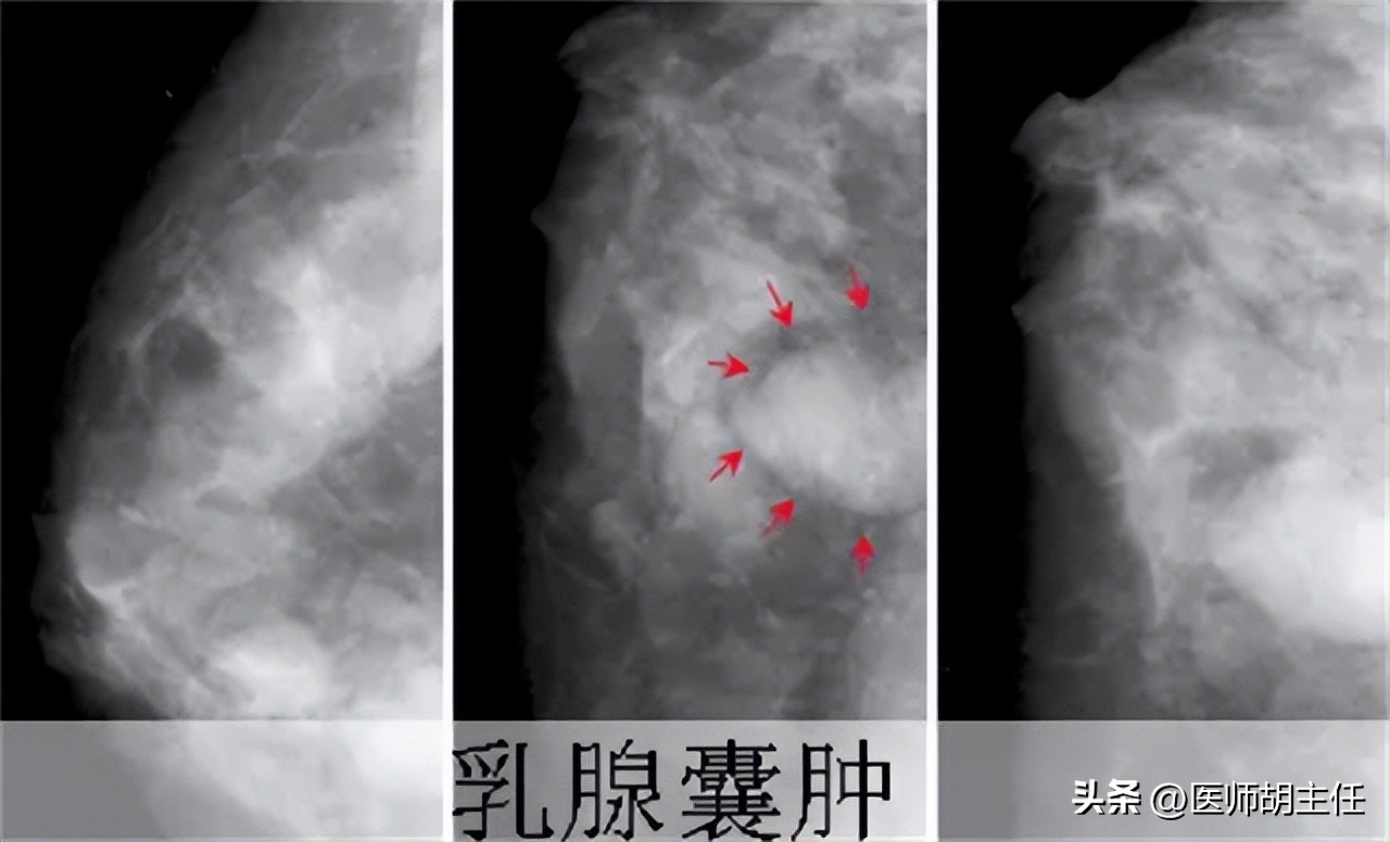 体检肝部囊肿最大2.8怎么办,体检发现肝囊肿肾囊肿