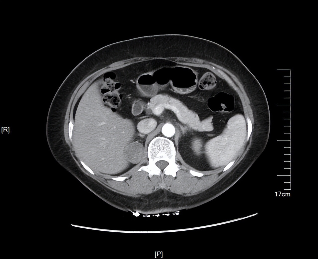 膀胱癌的诊断与鉴别诊断,膀胱癌的诊断与治疗