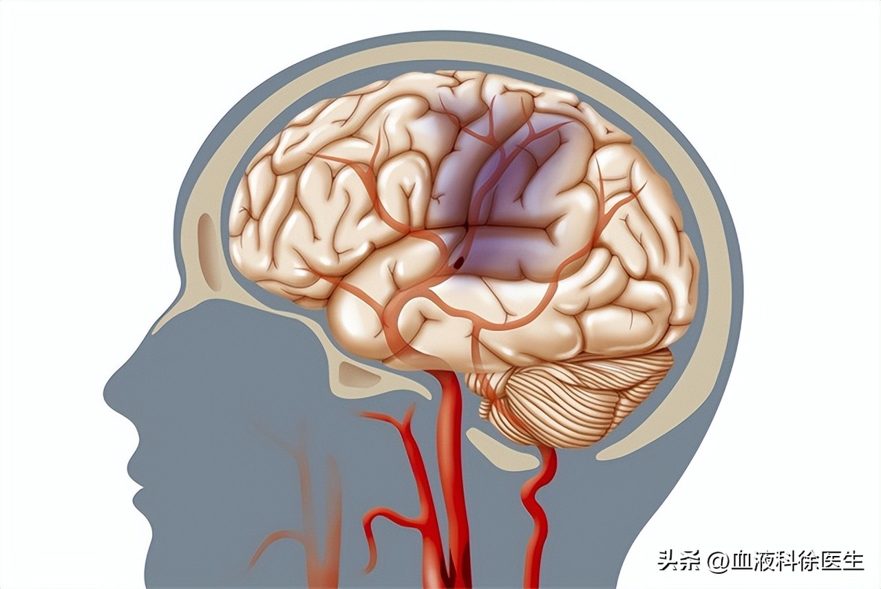 为什么脑血栓都是赌博惹的祸,为什么得了脑血栓会反复发高烧