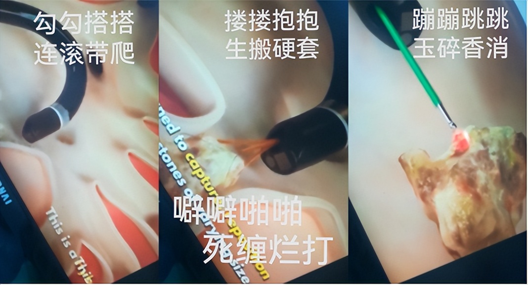 明知山有虎,偏向虎山行——肾斗士VS肾结石