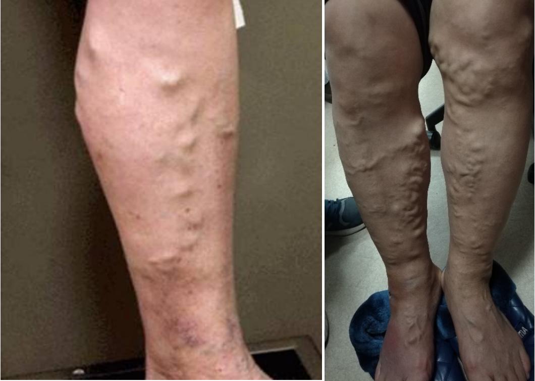 缓解静脉曲张简单实用不花冤枉钱,精索静脉曲张吃药能缓解疼痛吗