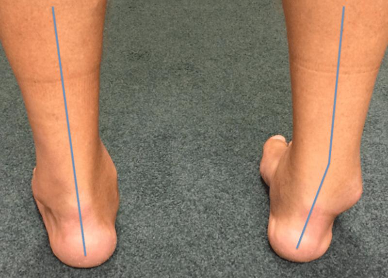 习惯性崴脚可以彻底治好吗,习惯性崴脚后怎么办