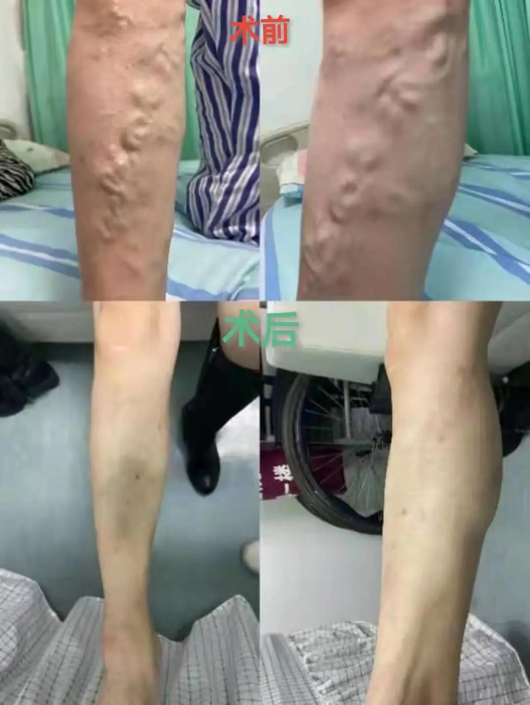 激光治疗下肢静脉曲张,精索静脉曲张微创和激光是一样吗