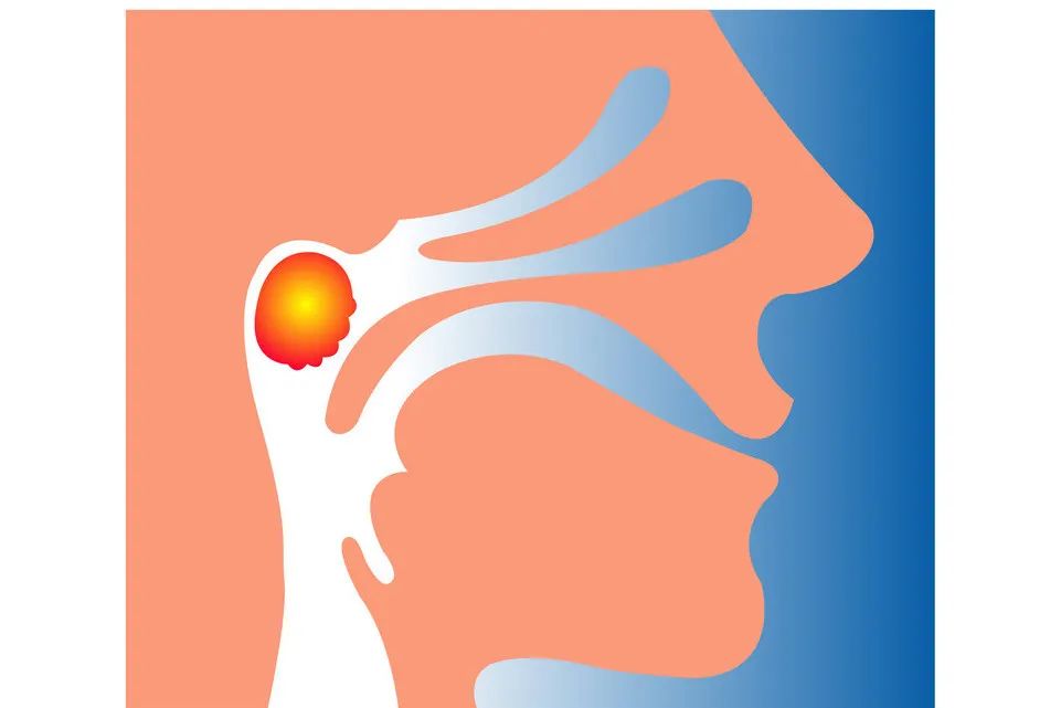 低龄儿童腺样体肥大,儿童腺样体肥大看中医如何治疗