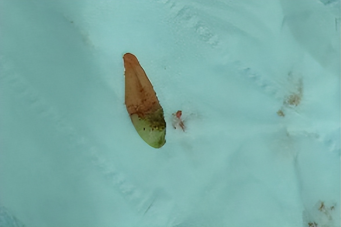 摔掉牙齿怎么补救,摔了一跤牙怎么快速牢固