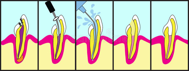 根管治疗之后牙痛正常吗,为什么做根管治疗后牙还是很痛