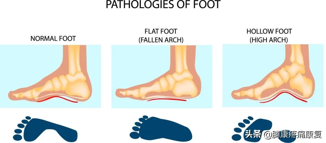 功能性高足弓的练习方式,用什么方法舒缓足弓疼痛